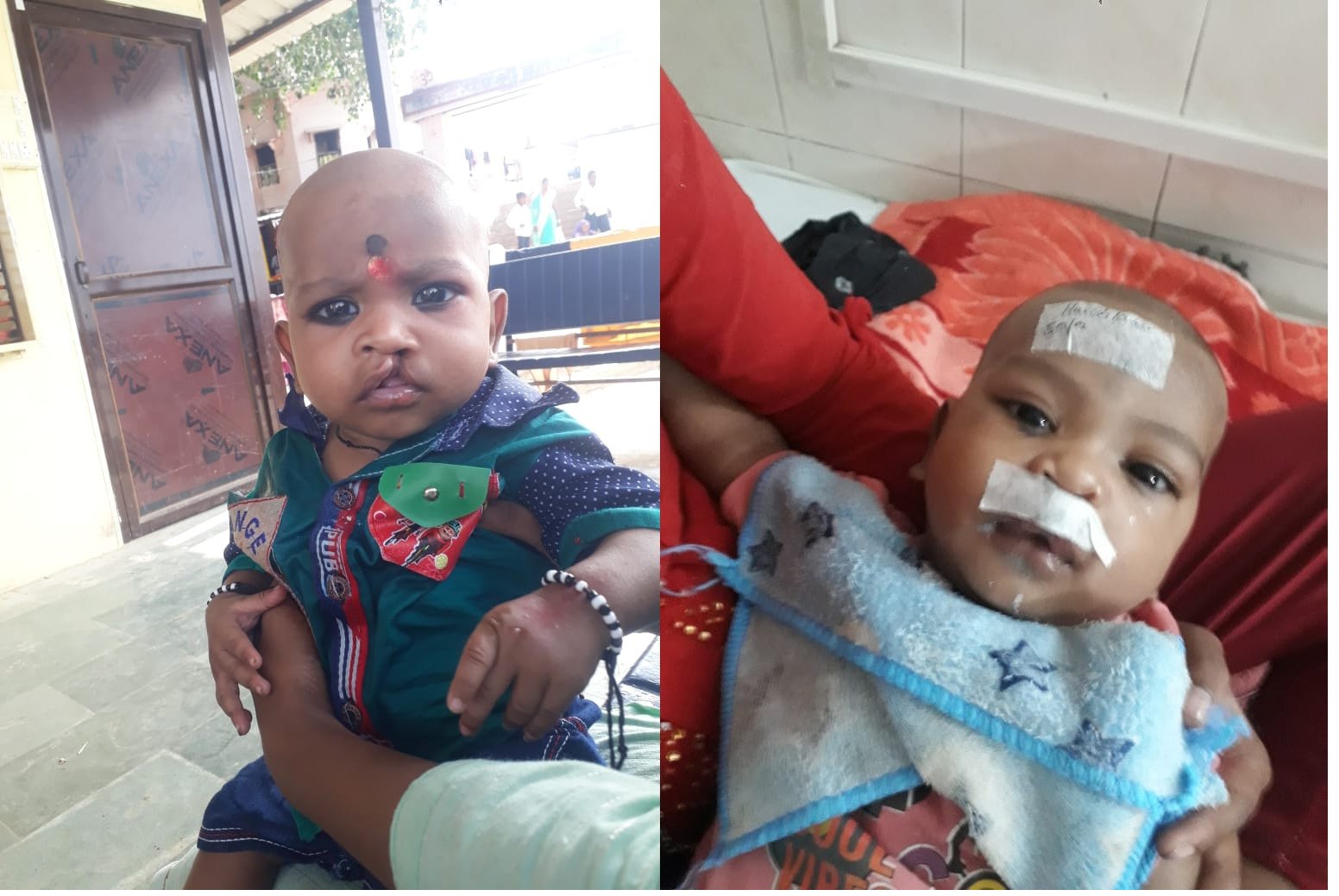 देवकली ब्लाक मे एक वर्ष के अन्दर दर्जनों जन्मजात दोष युक्त बच्चों का निःशुल्क आपरेशन